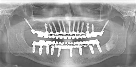 Dental Implantsfixed Teeth For Every One Dental Implant Speciality