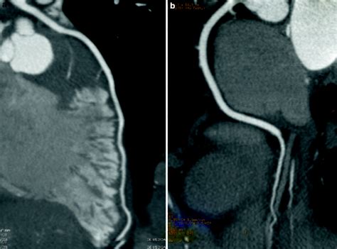 Coronary Atherosclerosis Imaging By Coronary Ct Angiography Radiology Key