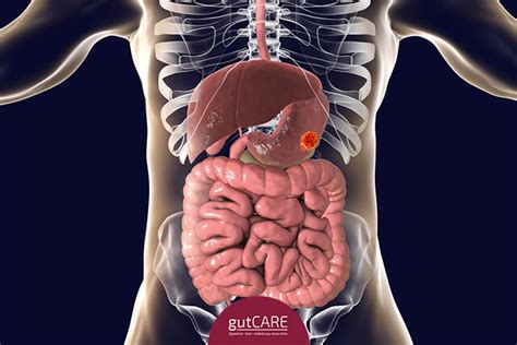Cure stomach ulcer naturally stomach ulcer home remedy (tamil. Identifying The Symptoms And Risk Factors Of Stomach Cancer