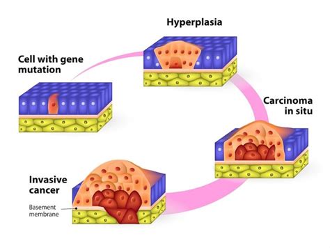 Idaho Falls Skin Cancer Treatment High Valley Dermatology