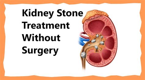 Kidney Stone Kidney Stone Treatment Kidney Stone Treatment In