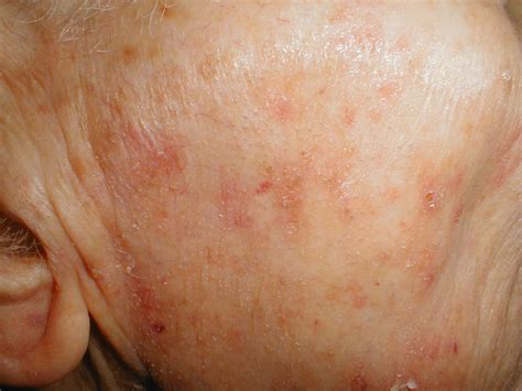 Actinic Keratosis Complete The Form