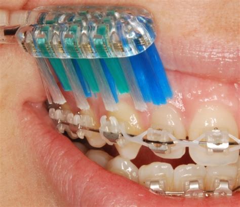 How To Look After Your Braces Platinum Orthodontics
