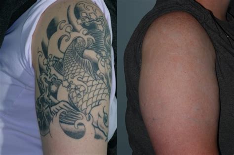 Costs less than one laser treatment. Laser tattoo removal. 6 Tattoo removal lasers including ...