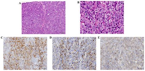 Rapidly Progressing Large Cell Neuroendocrine Carcinoma Arising From The Uterine Corpus A Case