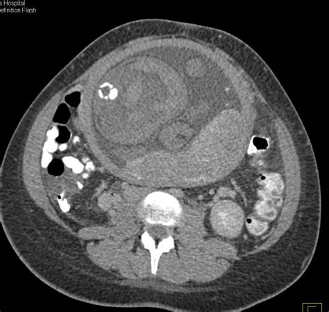 Acute Pyelonephritis In A Pregnant Patient Kidney Case Studies