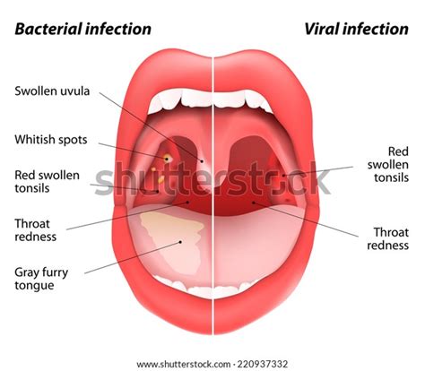 Differences Between Viral Bacterial Infections Open Stok Vektör Telifsiz Shutterstock