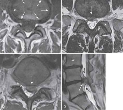 Facet Arthropathy Aging Spine Mitch Medical