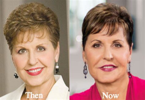 Joyce Meyer Plastic Surgery Before And After Photos