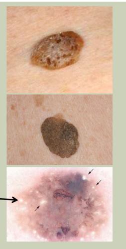 Benign Skin Lesions Flashcards Quizlet