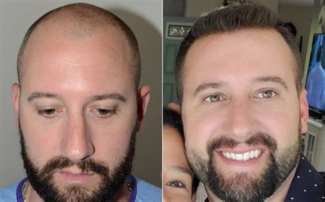 Hair Transplants For Men Photos Miami FL Patient117285