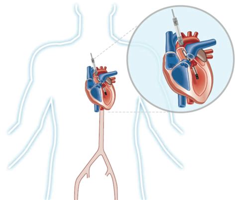 Fda Likely To Approve Expanded Indication Of Abiomeds Impella Heart Pump Sec Filing Keystone