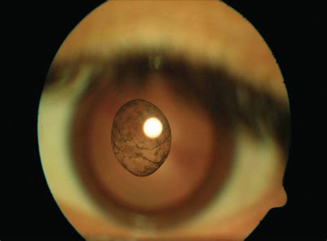 Idiopathic Pigmented Vitreous Cyst | Ophthalmology | JAMA ...