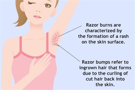 Razor Burn 8 Home Treatment And Prevention Tips