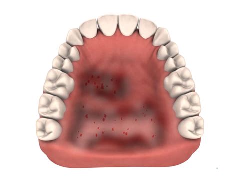 Effects Of Tobacco On The Oral Cavity Nicotine Stomatitis Odontovida