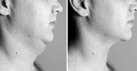 Double Chin Reduction Mediluxe