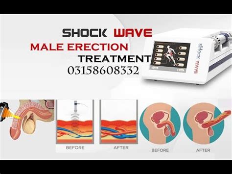 Erectile Dysfunction Shockwave Therapy In Lahore YouTube