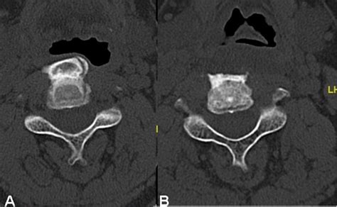 Comparison Of Cervical Spine Axial Ct Scans At C3 Level Pre Op A And