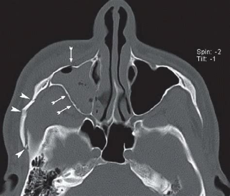 Zmc Fracture Radiology Key