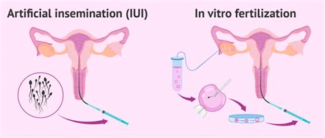 Differences In The Iui And Ivf Process