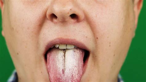 Fissured Tongue Causes And Treatment
