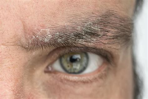 Treatment For Psoriasis On The Eyelid Tratament