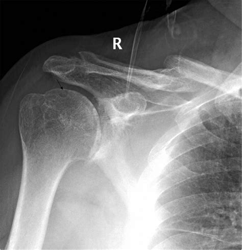 Plain Radiographs Of The Right Shoulder Showed Glenohumeral Joint Space