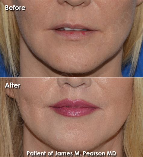 Lip Lift Photos Before And After Dr James Pearson Facial Plastic Surgery