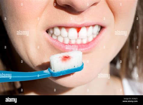 Woman With Bleeding Gums During Teeth Brushing Periodontal Disease