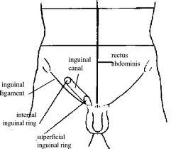 Same as males groin protector was designed for man female groin. COCHIN CARDIAC CLUB: HERNIA