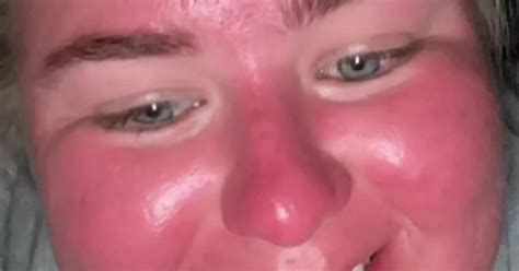 Womans Terrible Sunburn Makes Her Face Blister And Double In Size