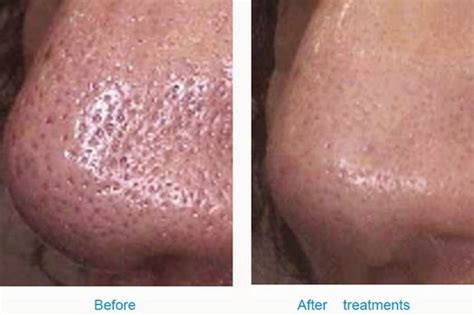 Large Pores Southern Cosmetic Laser Charleston Botox Massage And