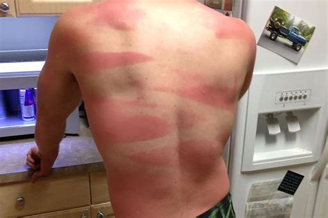 People Share Worst Sunburn Ever With One Woman