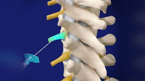 What To Expect After An Epidural Steroid Injection For Back Pain Faqs Pain Medicine Group