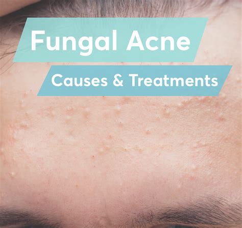 Fungal Acne Caused By Mask 5famousprayers