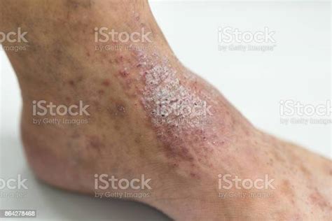 Atopic Dermatitis At Foot Stock Photo Download Image Now Istock