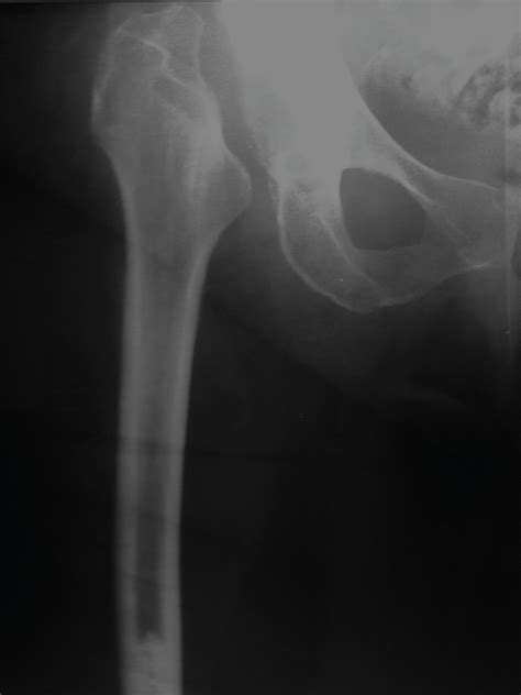 Girdlestone Resection Arthroplasty A Salvage Procedure For Severe