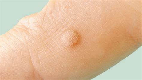 Causes Of Hand Warts
