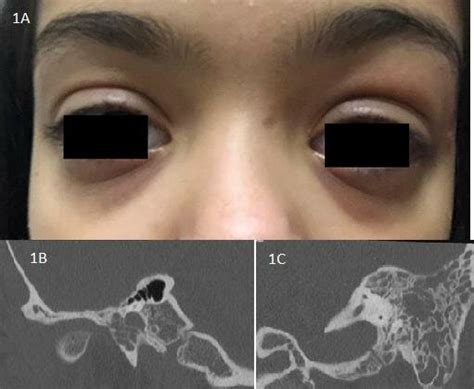 A Proptosis Upper Lid Swelling Mild Ptosis And Hyperemia In The Left