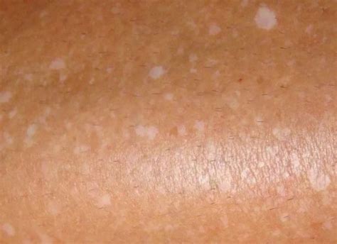 White Spots On Legs And Some Basic Remedies