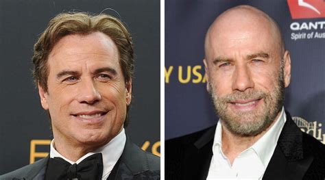 Celebrities With Hair Transplants Scalp Micro Usa