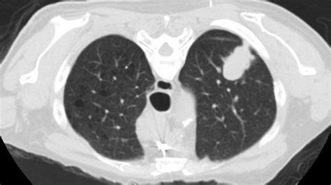 Lung cancer is the no. What Does A Ct Scan Of Lung Cancer Look Like - ct scan machine