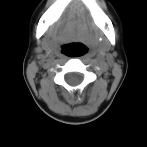 Submandibular Duct Stone Hospital Corners Radiology Head And Neck