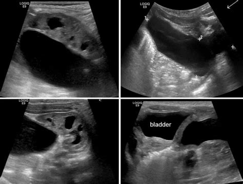 Selected Images From Abdominal Ultrasound Showing The Cyst And Its