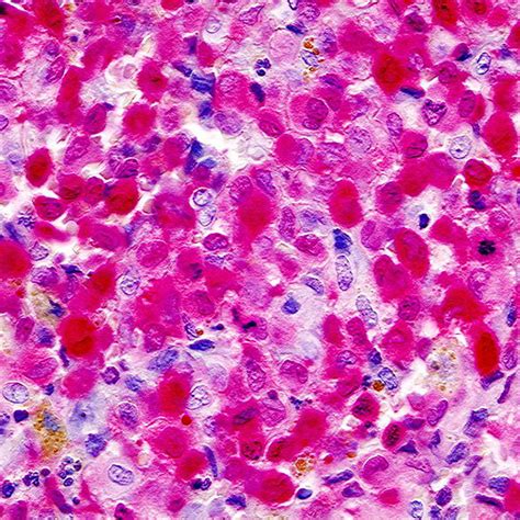 Eosinophilic Granuloma Histology Image