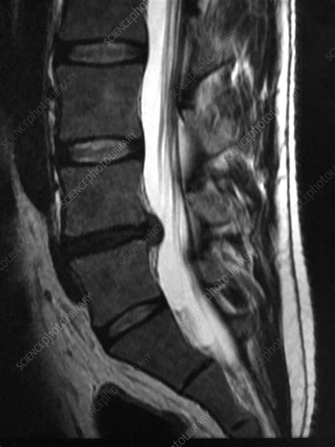 Lumbar Disc Herniation Mri The Best Porn Website