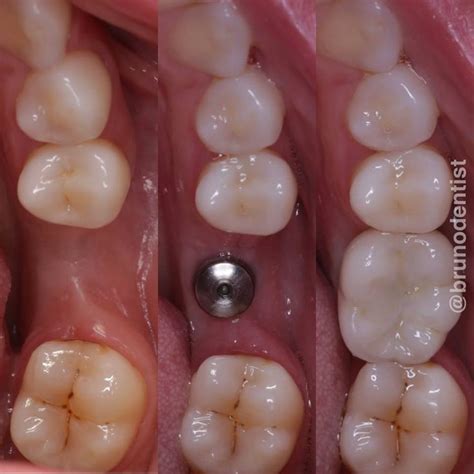Molar Tooth Replacement