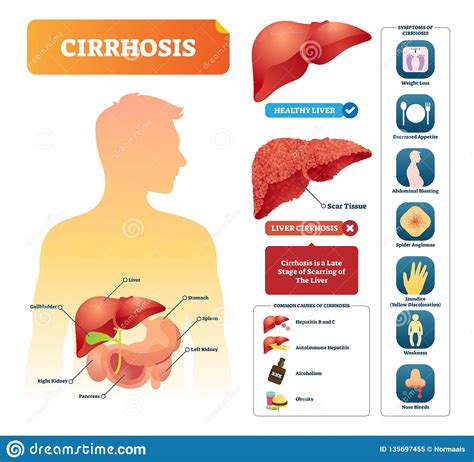 Cirrhosis is a chronic liver disease often associated with alcoholism. Cirrhosis Vector Illustration. Labeled Medical Diagram ...