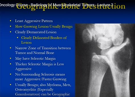 Radiology Of Musculoskeletal Tumors —