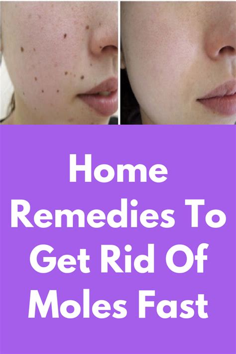How To Get Rid Of Moles Lip Howotremvo